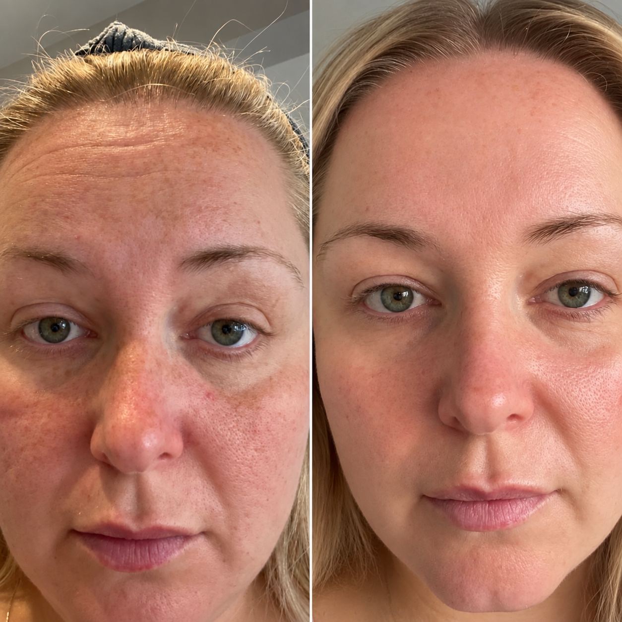 Résultat avant/après Bare Rituals® — peau plus lumineuse et hydratée après cure de compléments alimentaires beauté