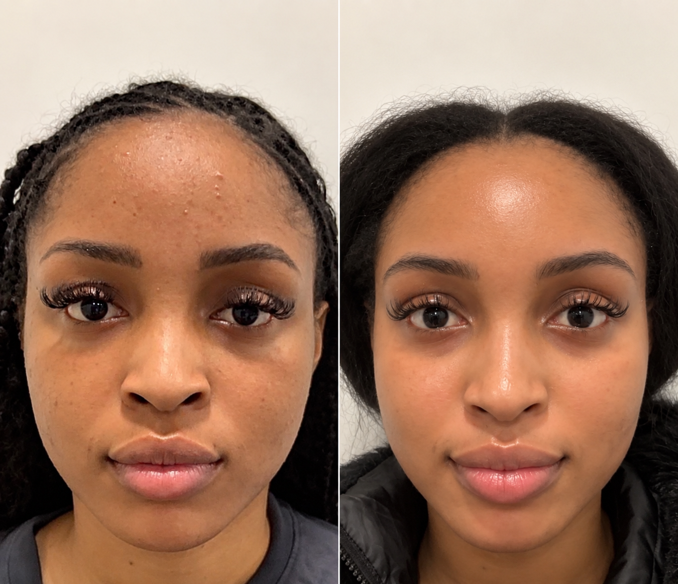 Résultat avant/après Bare Rituals® — peau visiblement transformée après 3 mois de cure The Glow Ritual
